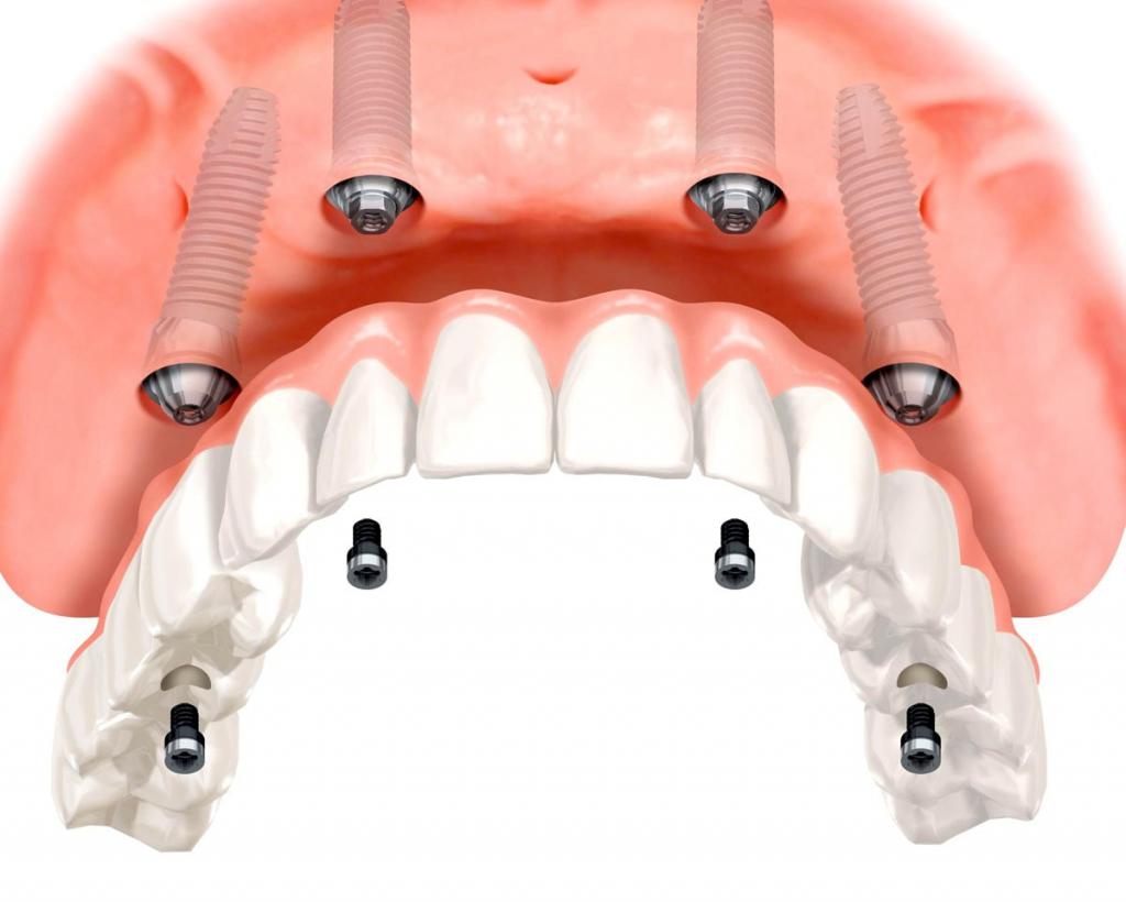 Имплантация верхней челюсти